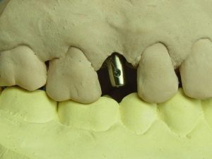 Limpeza da interface para implante antes da cimentação
