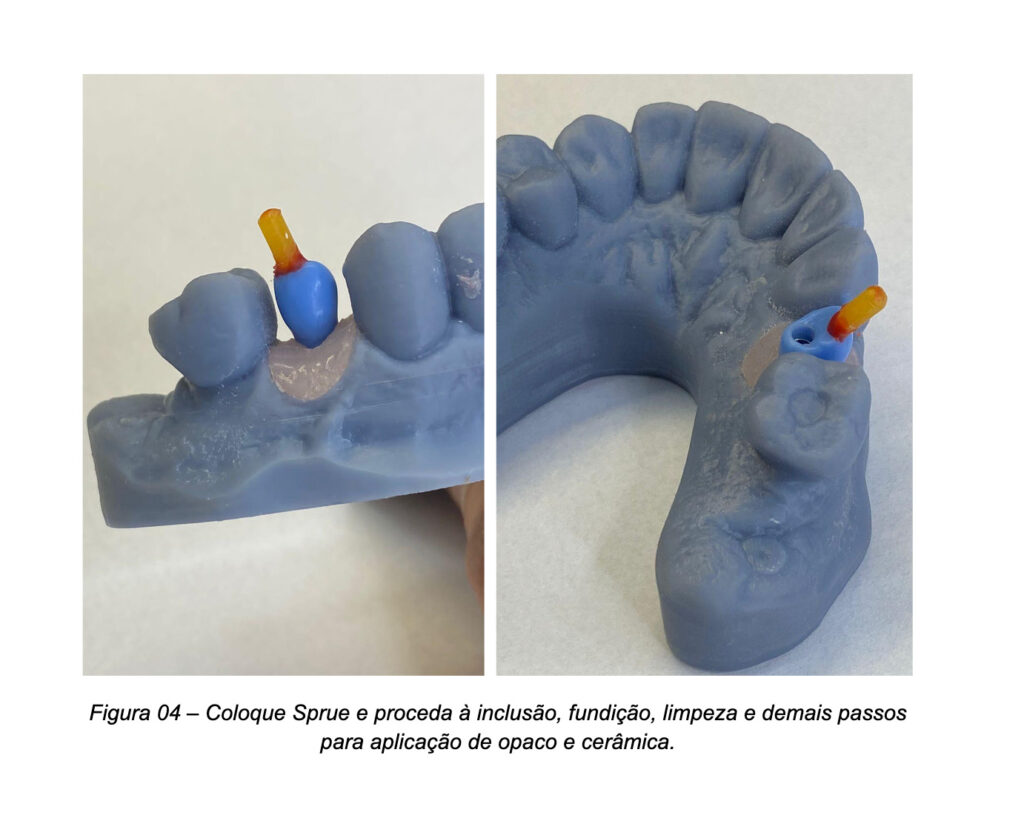 Modelo digital para prótese sobre Pilar UniFit